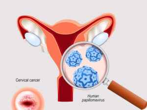 Read more about the article CERVICAL Cancer – Causes, Symptoms, Risks & Screening