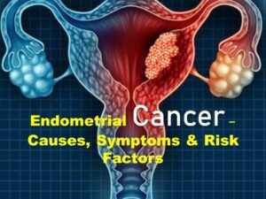Read more about the article Endometrial Cancer Causes, Symptoms, Diagnosis and Treatment