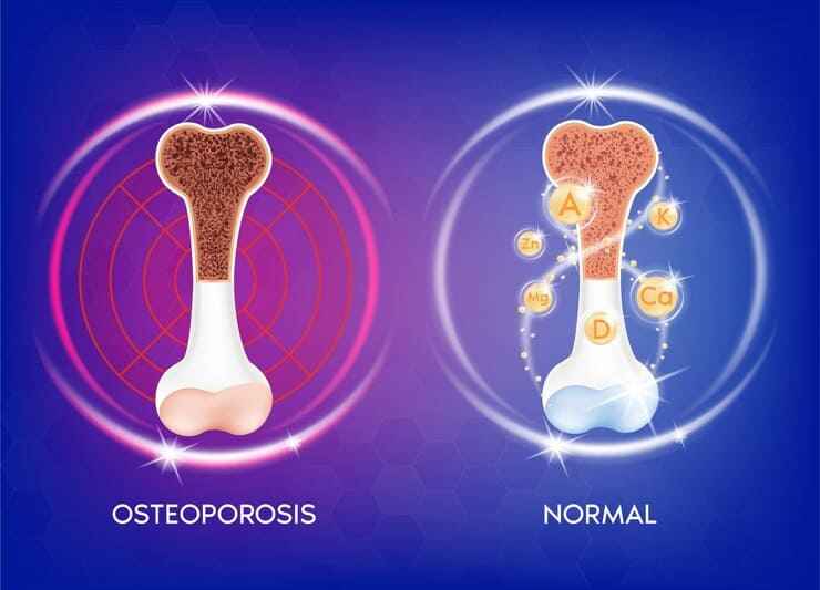You are currently viewing Postmenopausal Osteoporosis: Symptoms, Screening, and Treatment