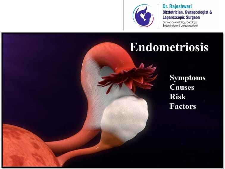 You are currently viewing Endometriosis – Causes, Risk Factors and Symptoms