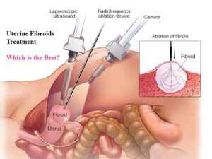 Read more about the article Uterine Fibroids Treatment – Which is the Best?