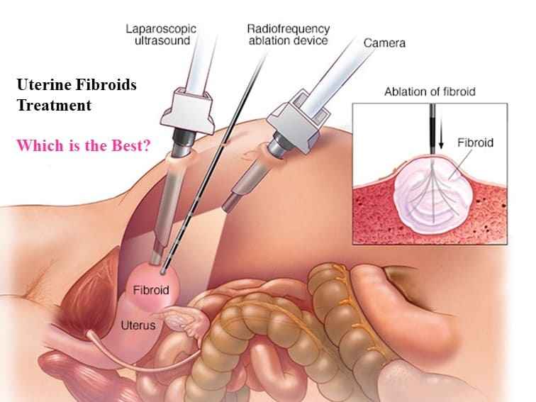 Read more about the article Uterine Fibroids Treatment – Which is the Best?