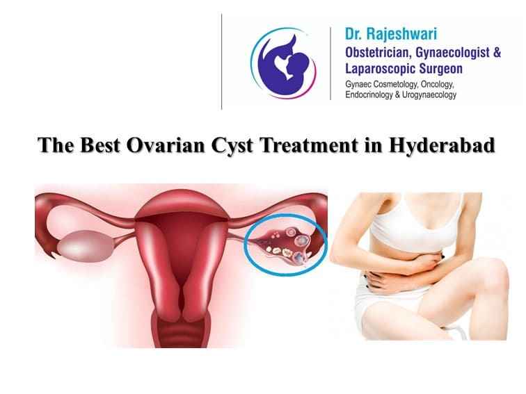 You are currently viewing Ovarian Cyst Treatment – Which is the Best | Dr Rajeshwari Reddy
