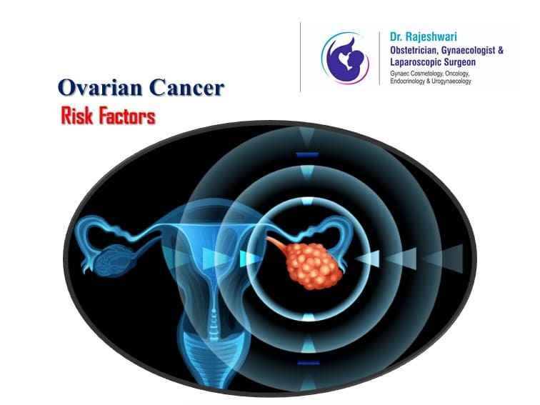 You are currently viewing Ovarian Cancer (Tumour) – What is Your Personal Risk?